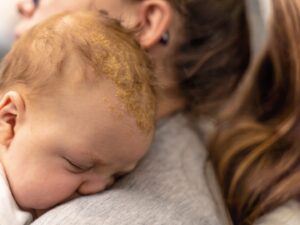 Un bambino con la crosta lattea sul suo cuoio capelluto riposa appoggiato alla spalla della mamma