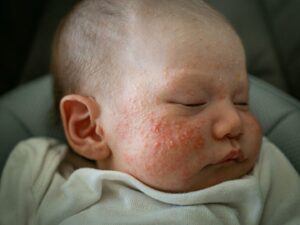 Un bambino con l'acne neonatale sul viso